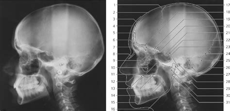 Xray Of Skull Lateral View Showing Sinuses And Sella My XXX Hot Girl