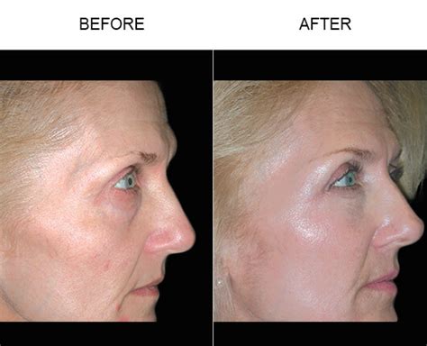 Cheek Lift Mid Face Lift Before And After Dr James Pearson Facial