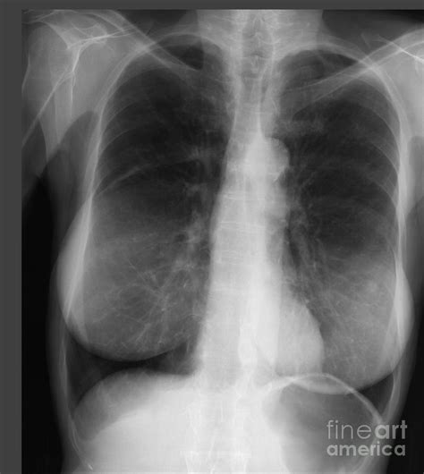 Chest X Ray Of Female Photograph By Ted Kinsman Pixels