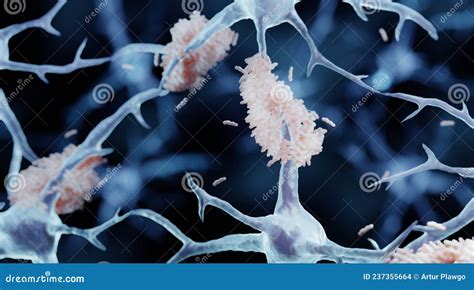 Amyloid Plaque In Alzheimer Disease Stock Illustration Illustration