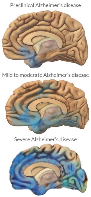 Lornoxicam · The Stages Of Alzheimers