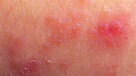 Skin Lesions 45 Causes With Pictures Types And Treatments
