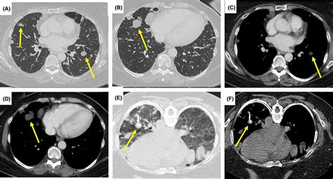 An Unusual Cause Of Multiple Incidental Lung Nodules Sala 2020