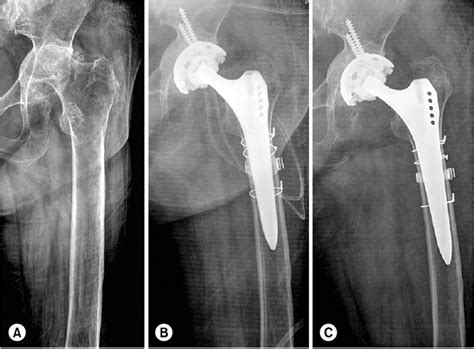 A This Patient Suffered From Left Hip Pain Associated With Rheumatoid