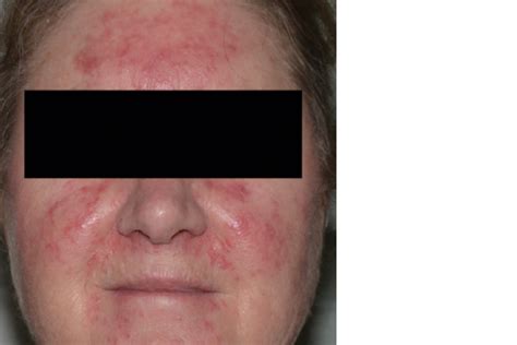 A Woman With Rosy Cheeks And Erythematous Facial Lesions Medicine Today