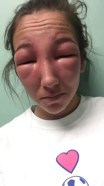 People Are Losing It Over A Photo Of This Girl With Poison Ivy On Her Eyes