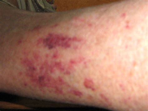 Skin Rashes On Lower Leg Pictures Photos