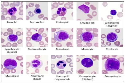 Acute Myeloid Leukemia Aml Morphology What To Know Hot Sex Picture