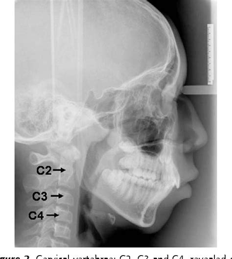 Figure 2 From Radiographic Assessment Of Skeletal Maturation Stages For