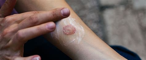 How Bad Is It To Get Ringworm Afc Urgent Care