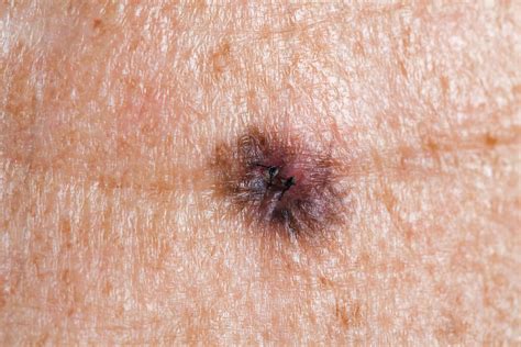 Medical Lentigo Maligna Melanoma Gcma