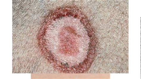 Stages Of Ringworm