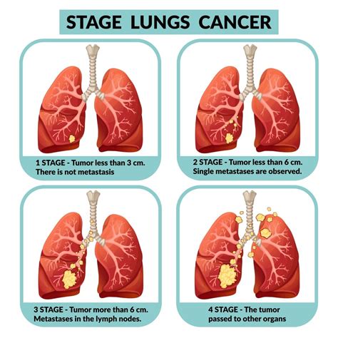 Stage 4 Lung Cancer Chemo