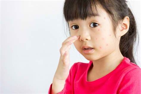 Kenali Gejala Alergi Pada Anak Dan Cara Mengatasinya Alodokter