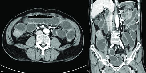 Abdominopelvic Computed Tomography Scans Indicate The Obstruction Of