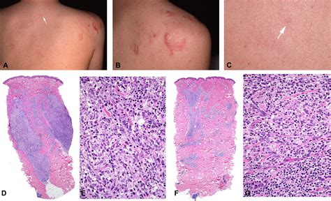 Clinicopathologic Features Of Early Lesions Of Primary Cutaneous