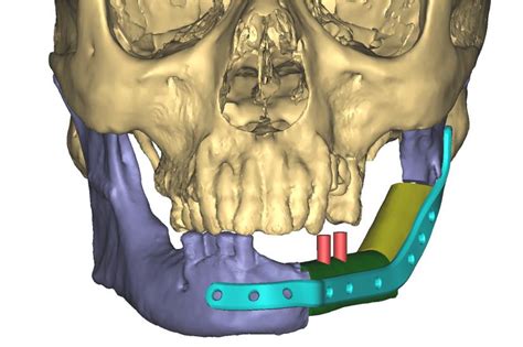 Facial And Oral Cancer Surgery Medical Orofacial Surgery