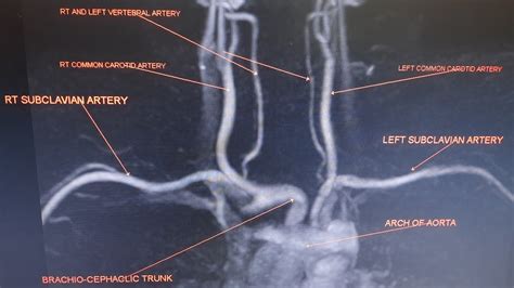 Mr Angiography Of Bilateral Subclavian Arteries Without Contrast Youtube