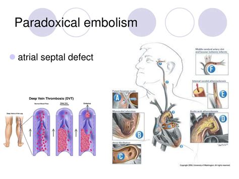 Ppt Cerebrovascular Accident Cva Powerpoint Presentation Free