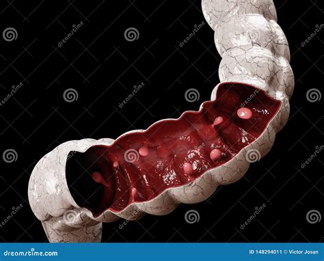 Colon Polyps 3d Illustration Polyp In The Intestine Stock