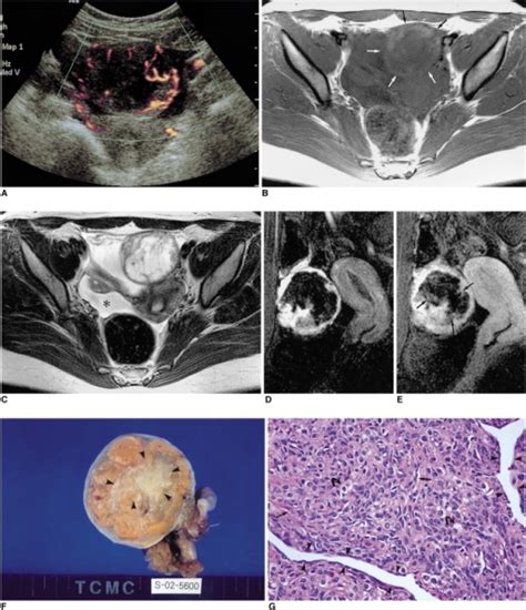 Sclerosing Stromal Tumor Of The Left Ovary In A 16 Year Open I