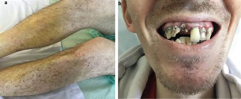 Images Of The Month 1 ‘the Scurvy Diagnosis By Gestalt Rcp Journals