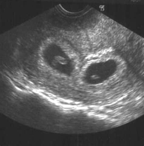 List 97 Pictures Twin Ultrasound Pictures At 8 Weeks Updated