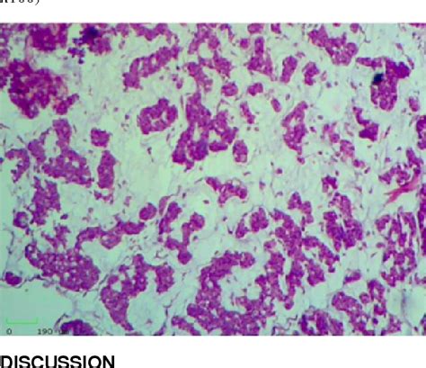 Figure 1 From A Rare Case Of Mucinous Carcinoma Of The Breast