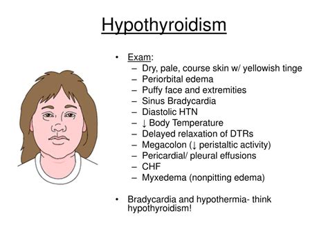 Periorbital Edema Hypothyroidism