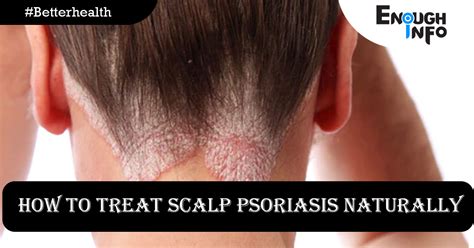 How To Treat Scalp Psoriasis Naturally 10 Home Remedies Enoughinfo