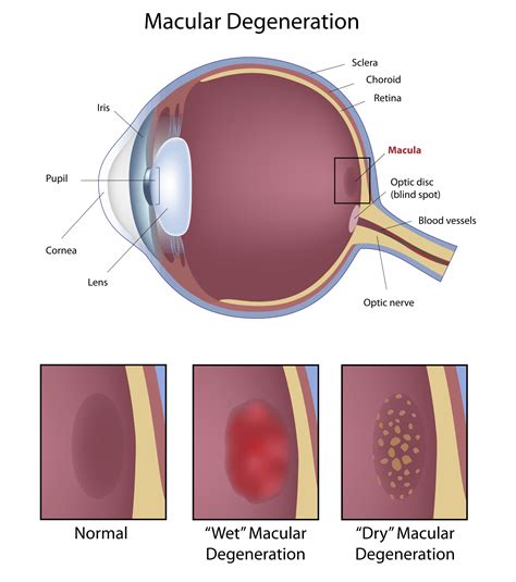 Macular Degeneration Petrou Eye Care