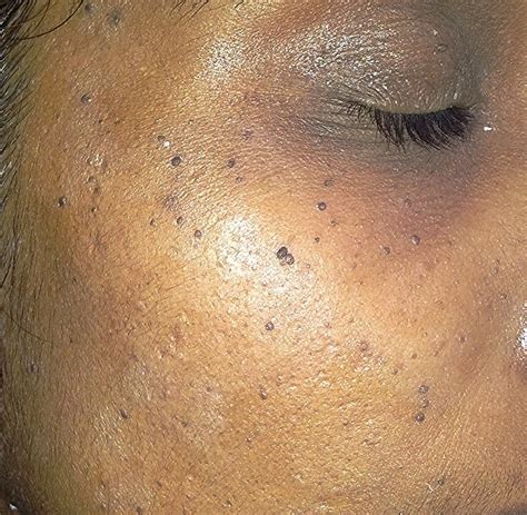 common causes of brown spots on the face and how to g