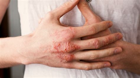 What Causes Eczema And Other Faqs Puriya Blog