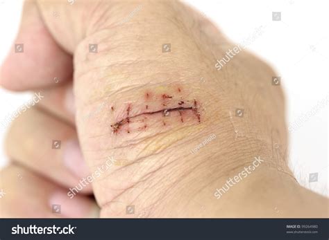 Closeup Hand Wound Stitches Stock Photo 99264980 Shutterstock
