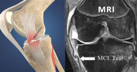Mcl Reconstruction Surgery In Chennai Medial Collateral Ligament