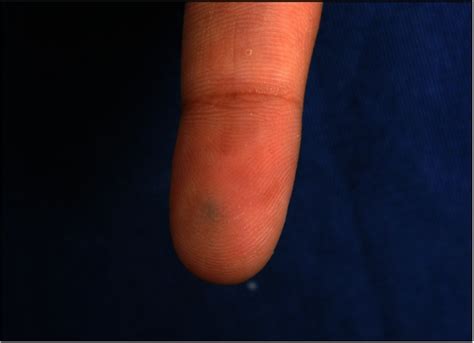 A Bluish Nodule On The Left Second Finger Patient 6 Download