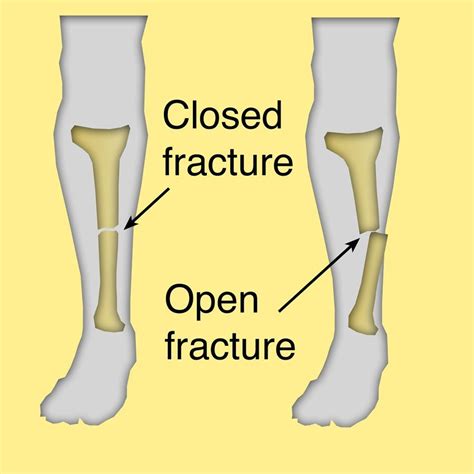 A Closed Fracture Does Not