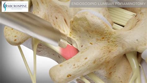 Endoscopic Lumbar Foraminotomy Youtube
