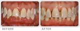 Pictures of Non Surgical Periodontal Treatment