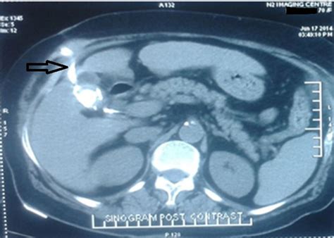 Spontaneous Cholecystocutaneous Fistula Empirically Treated For A