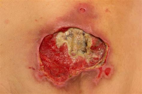Skin Ulcers Types Causes And Effective Treatment Options