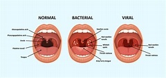 Strep throat unmasked: understanding symptoms and treatment