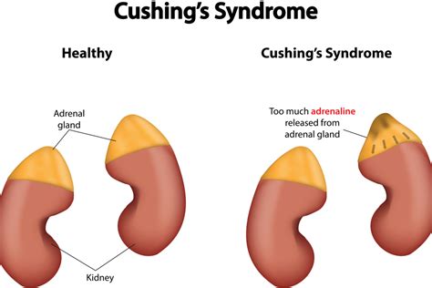 Sindromul Cushing Cauze Simptome Diagnostic Tratament Bioclinica My