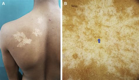 Dermoscopy Of Pigmentary Disorders In Brown Skin Dermatologic Clinics