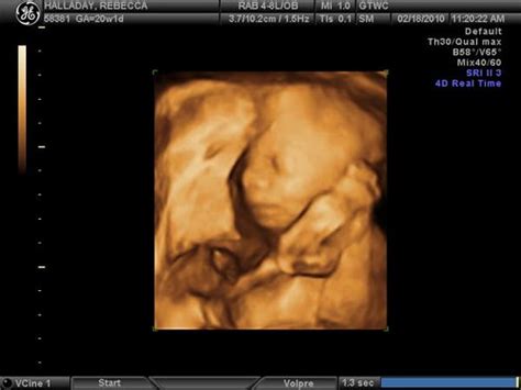 20 Weeks Ultrasound Photo Submitted By Babies Online