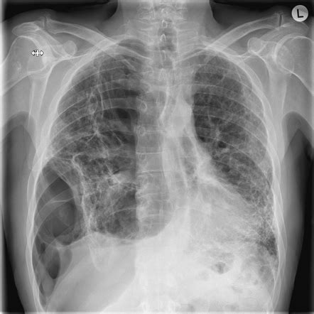 Loculated Pneumothorax Radiology Reference Article Radiopaedia Org