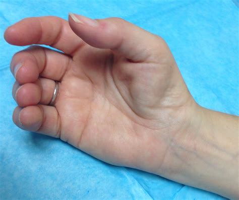 Thenar Muscle Atrophy Hand Surgery Source