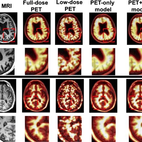 Example Of Simulated 1 Amyloid Petmri Imaging In A Patient With A A