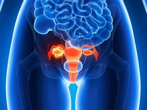 Cervical Cancer Causes Signs Treatment