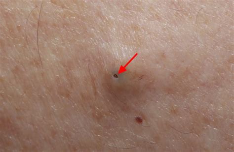 Epidermoid Cyst Infected Causes Symptomstreatment
